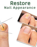 5X Quick-healing Nail Fungus Ointment  BUY 1 GET 1 FREE 🔥