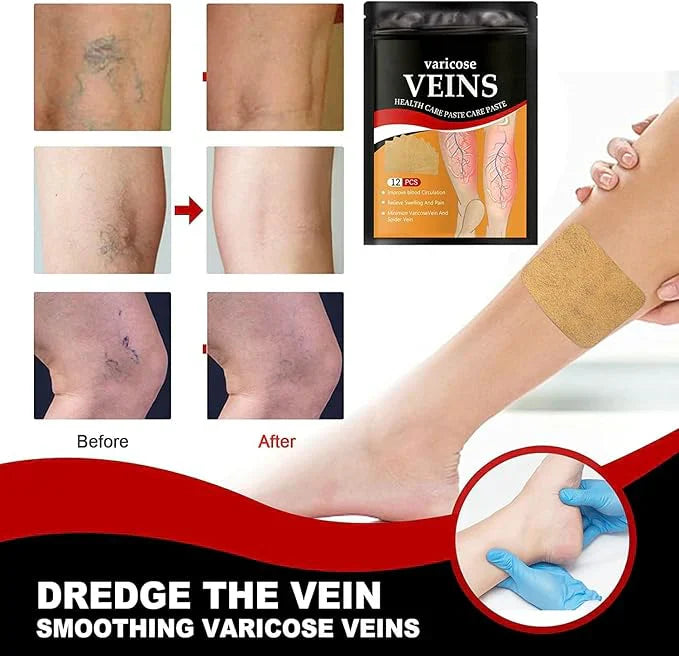 VeinGuard™-Varicose Vein Patches BOX Of 4 Packs (BUY 1 GET 1 FREE🔥)