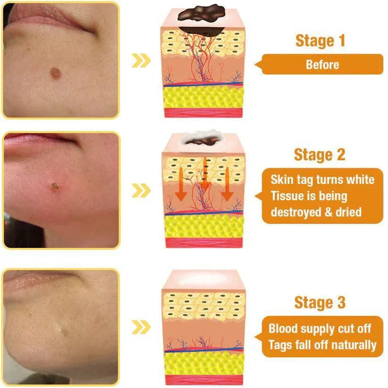 🪔Diwali Sale 50%+ OFF Bee Venom Wart Remover Spray 30ml Buy 1 Get 1 Free!!😍