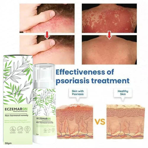 Eczemaron™️Anti Fungal Spray [BUY 1 GET 1 FREE!🔥]  On Sale 🔥
