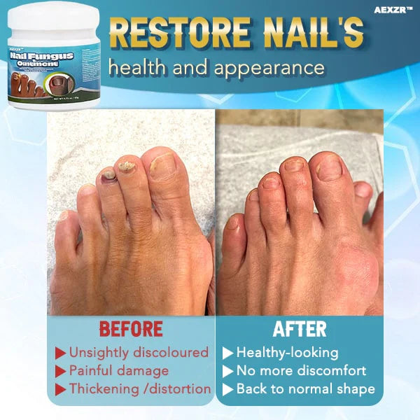 5X Quick-healing Nail Fungus Ointment  BUY 1 GET 1 FREE 🔥