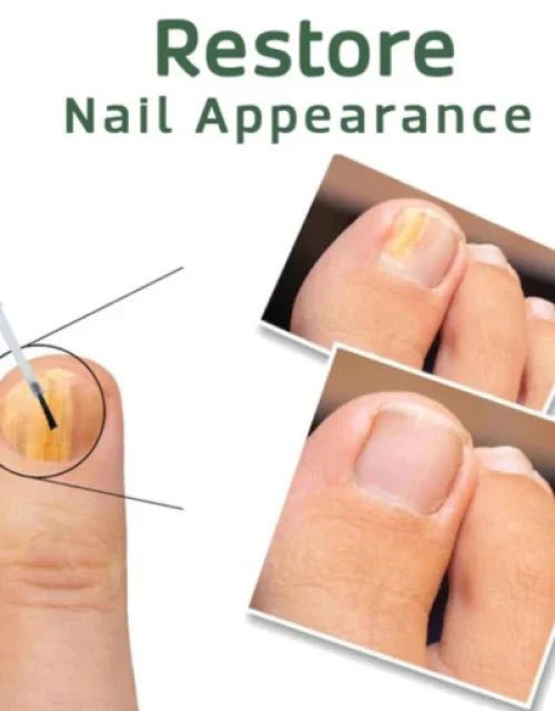 5X Quick-healing Nail Fungus Ointment  BUY 1 GET 1 FREE 🔥